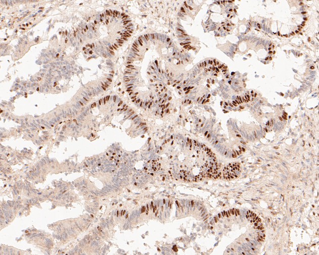 Immunohistochemical analysis of paraffin-embedded human colon carcinoma tissue using anti-GAPDH antibody. The section was pre-treated using heat mediated antigen retrieval with sodium citrate buffer (pH 6.0) for 20 minutes. The tissues were blocked in 5% BSA for 30 minutes at room temperature, washed with ddH2O and PBS, and then probed with the primary antibody (EM1901-57, 1/50)  for 30 minutes at room temperature. The detection was performed using an HRP conjugated compact polymer system. DAB was used as the chromogen. Tissues were counterstained with hematoxylin and mounted with DPX.