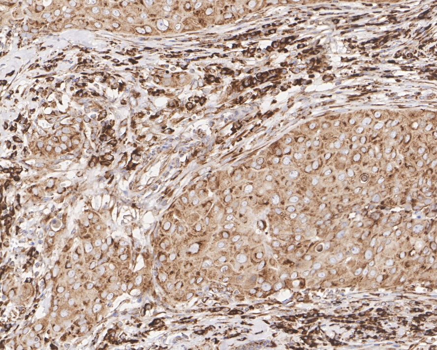 Immunohistochemical analysis of paraffin-embedded human breast carcinoma tissue using anti-LYRIC antibody. The section was pre-treated using heat mediated antigen retrieval with Tris-EDTA buffer (pH 8.0-8.4) for 20 minutes.The tissues were blocked in 5% BSA for 30 minutes at room temperature, washed with ddH2O and PBS, and then probed with the primary antibody (EM1901-60, 1/50) for 30 minutes at room temperature. The detection was performed using an HRP conjugated compact polymer system. DAB was used as the chromogen. Tissues were counterstained with hematoxylin and mounted with DPX.
