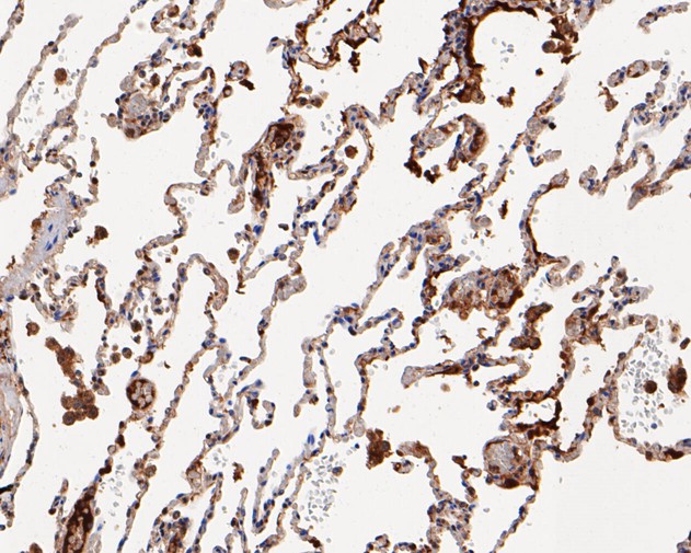 Immunohistochemical analysis of paraffin-embedded human lung carcinoma tissue using anti-UBA3 antibody. The section was pre-treated using heat mediated antigen retrieval with sodium citrate buffer (pH 6.0) for 20 minutes. The tissues were blocked in 5% BSA for 30 minutes at room temperature, washed with ddH2O and PBS, and then probed with the primary antibody (EM1901-64, 1/200)  for 30 minutes at room temperature. The detection was performed using an HRP conjugated compact polymer system. DAB was used as the chromogen. Tissues were counterstained with hematoxylin and mounted with DPX.