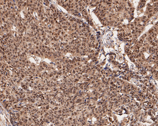 Immunohistochemical analysis of paraffin-embedded human breast carcinoma tissue using anti-UBA3 antibody. The section was pre-treated using heat mediated antigen retrieval with sodium citrate buffer (pH 6.0) for 20 minutes. The tissues were blocked in 5% BSA for 30 minutes at room temperature, washed with ddH2O and PBS, and then probed with the primary antibody (EM1901-64, 1/200)  for 30 minutes at room temperature. The detection was performed using an HRP conjugated compact polymer system. DAB was used as the chromogen. Tissues were counterstained with hematoxylin and mounted with DPX.