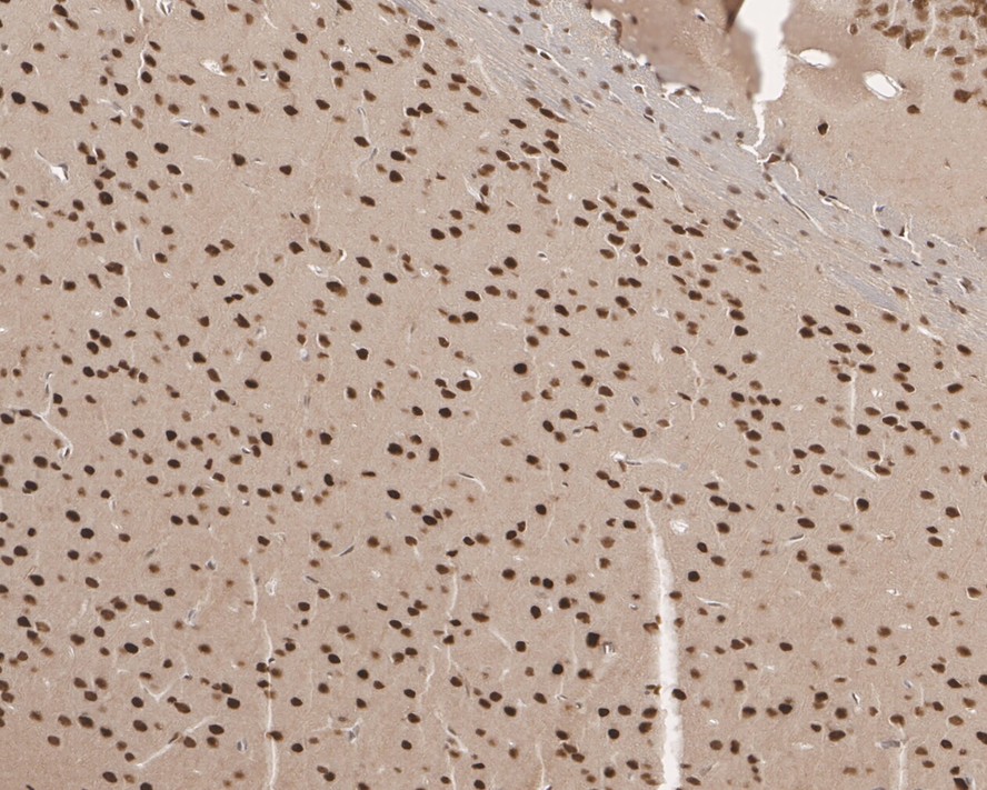 Immunohistochemical analysis of paraffin-embedded human lung carcinoma tissue using anti-UBA3 antibody. The section was pre-treated using heat mediated antigen retrieval with sodium citrate buffer (pH 6.0) for 20 minutes. The tissues were blocked in 5% BSA for 30 minutes at room temperature, washed with ddH2O and PBS, and then probed with the primary antibody (EM1901-65, 1/400)  for 30 minutes at room temperature. The detection was performed using an HRP conjugated compact polymer system. DAB was used as the chromogen. Tissues were counterstained with hematoxylin and mounted with DPX.