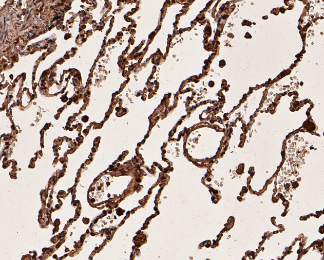 Immunohistochemical analysis of paraffin-embedded human breast carcinoma tissue using anti-UBA3 antibody. The section was pre-treated using heat mediated antigen retrieval with sodium citrate buffer (pH 6.0) for 20 minutes. The tissues were blocked in 5% BSA for 30 minutes at room temperature, washed with ddH2O and PBS, and then probed with the primary antibody (EM1901-65, 1/200)  for 30 minutes at room temperature. The detection was performed using an HRP conjugated compact polymer system. DAB was used as the chromogen. Tissues were counterstained with hematoxylin and mounted with DPX.