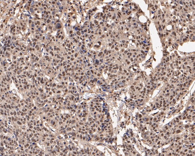 Immunohistochemical analysis of paraffin-embedded human lung carcinoma tissue using anti-UBA3 antibody. The section was pre-treated using heat mediated antigen retrieval with sodium citrate buffer (pH 6.0) for 20 minutes. The tissues were blocked in 5% BSA for 30 minutes at room temperature, washed with ddH2O and PBS, and then probed with the primary antibody (EM1901-66, 1/200)  for 30 minutes at room temperature. The detection was performed using an HRP conjugated compact polymer system. DAB was used as the chromogen. Tissues were counterstained with hematoxylin and mounted with DPX.
