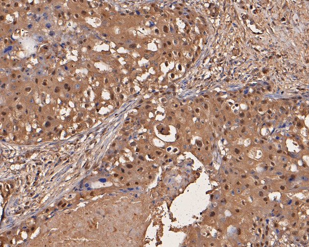 Immunohistochemical analysis of paraffin-embedded human breast tissue using anti-UBA3 antibody. The section was pre-treated using heat mediated antigen retrieval with sodium citrate buffer (pH 6.0) for 20 minutes. The tissues were blocked in 5% BSA for 30 minutes at room temperature, washed with ddH2O and PBS, and then probed with the primary antibody (EM1901-66, 1/200)  for 30 minutes at room temperature. The detection was performed using an HRP conjugated compact polymer system. DAB was used as the chromogen. Tissues were counterstained with hematoxylin and mounted with DPX.
