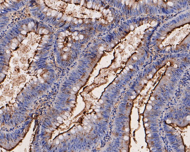 Immunohistochemical analysis of paraffin-embedded human colon carcinoma tissue using anti-CEACAM6 antibody. The section was pre-treated using heat mediated antigen retrieval with Tris-EDTA buffer (pH 8.0-8.4) for 20 minutes.The tissues were blocked in 5% BSA for 30 minutes at room temperature, washed with ddH2O and PBS, and then probed with the primary antibody (EM1901-68, 1/400) for 30 minutes at room temperature. The detection was performed using an HRP conjugated compact polymer system. DAB was used as the chromogen. Tissues were counterstained with hematoxylin and mounted with DPX.