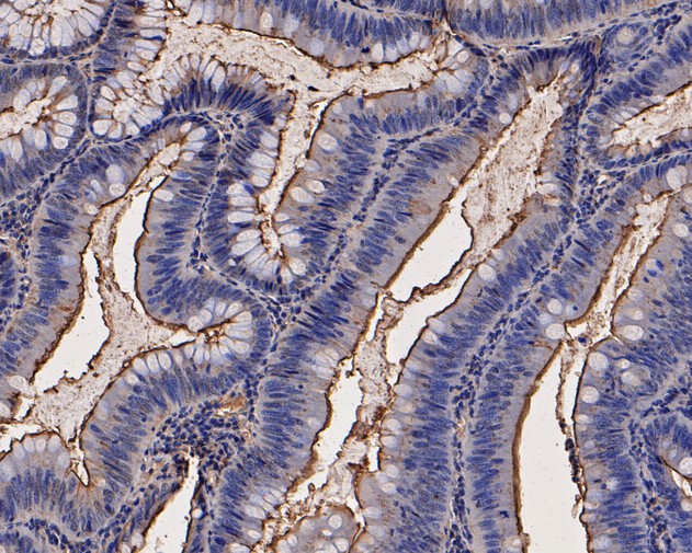 Immunohistochemical analysis of paraffin-embedded human colon carcinoma tissue using anti-CEACAM6 antibody. The section was pre-treated using heat mediated antigen retrieval with Tris-EDTA buffer (pH 8.0-8.4) for 20 minutes.The tissues were blocked in 5% BSA for 30 minutes at room temperature, washed with ddH2O and PBS, and then probed with the primary antibody (EM1901-69, 1/200) for 30 minutes at room temperature. The detection was performed using an HRP conjugated compact polymer system. DAB was used as the chromogen. Tissues were counterstained with hematoxylin and mounted with DPX.
