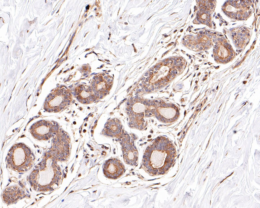 Immunohistochemical analysis of paraffin-embedded human breast  tissue with Mouse anti-ROBO1 antibody (EM1901-72) at 1/600 dilution.<br />
<br />
The section was pre-treated using heat mediated antigen retrieval with Tris-EDTA buffer (pH 9.0) for 20 minutes. The tissues were blocked in 1% BSA for 20 minutes at room temperature, washed with ddH2O and PBS, and then probed with the primary antibody (EM1901-72) at 1/600 dilution for 1 hour at room temperature. The detection was performed using an HRP conjugated compact polymer system. DAB was used as the chromogen. Tissues were counterstained with hematoxylin and mounted with DPX.
