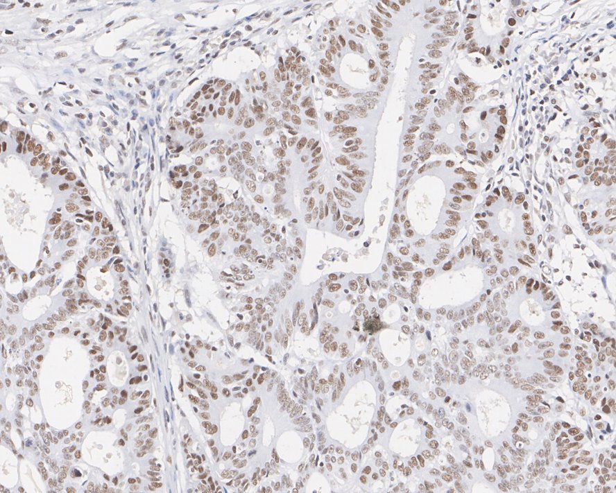 Immunohistochemical analysis of paraffin-embedded human colon carcinoma tissue using anti-MTA2 antibody. The section was pre-treated using heat mediated antigen retrieval with sodium citrate buffer (pH 6.0) for 20 minutes. The tissues were blocked in 5% BSA for 30 minutes at room temperature, washed with ddH2O and PBS, and then probed with the primary antibody (EM1901-74, 1/1,000)  for 30 minutes at room temperature. The detection was performed using an HRP conjugated compact polymer system. DAB was used as the chromogen. Tissues were counterstained with hematoxylin and mounted with DPX.