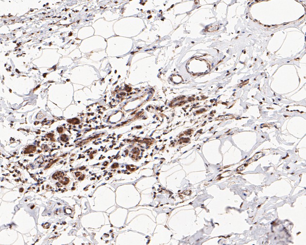 Immunohistochemical analysis of paraffin-embedded human breast carcinoma tissue using anti-MTA2 antibody. The section was pre-treated using heat mediated antigen retrieval with sodium citrate buffer (pH 6.0) for 20 minutes. The tissues were blocked in 5% BSA for 30 minutes at room temperature, washed with ddH2O and PBS, and then probed with the primary antibody (EM1901-74, 1/1,000)  for 30 minutes at room temperature. The detection was performed using an HRP conjugated compact polymer system. DAB was used as the chromogen. Tissues were counterstained with hematoxylin and mounted with DPX.