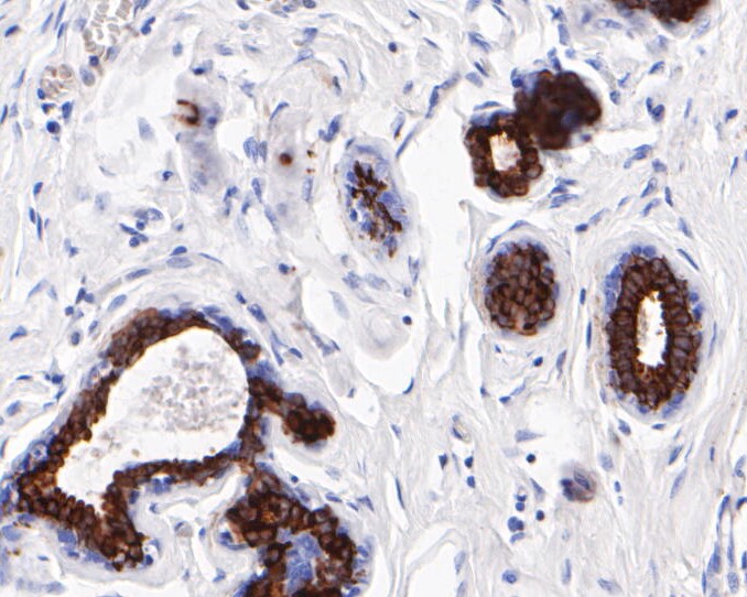Immunohistochemical analysis of paraffin-embedded human colon cancer tissue using anti-Cytokeratin 19 antibody. The section was pre-treated using heat mediated antigen retrieval with Tris-EDTA buffer (pH 8.0-8.4) for 20 minutes.The tissues were blocked in 5% BSA for 30 minutes at room temperature, washed with ddH2O and PBS, and then probed with the primary antibody (EM1901-75, 1/1000) for 30 minutes at room temperature. The detection was performed using an HRP conjugated compact polymer system. DAB was used as the chromogen. Tissues were counterstained with hematoxylin and mounted with DPX.