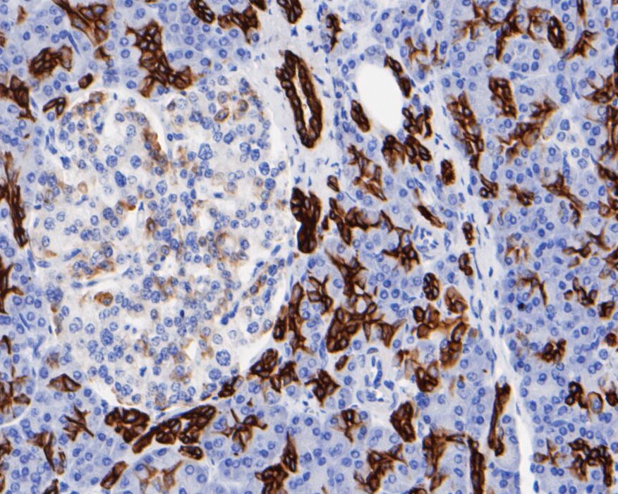 Immunohistochemical analysis of paraffin-embedded human colon cancer tissue using anti-Cytokeratin 19 antibody. The section was pre-treated using heat mediated antigen retrieval with Tris-EDTA buffer (pH 8.0-8.4) for 20 minutes.The tissues were blocked in 5% BSA for 30 minutes at room temperature, washed with ddH2O and PBS, and then probed with the primary antibody (EM1901-76, 1/1000) for 30 minutes at room temperature. The detection was performed using an HRP conjugated compact polymer system. DAB was used as the chromogen. Tissues were counterstained with hematoxylin and mounted with DPX.