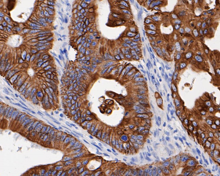 Immunohistochemical analysis of paraffin-embedded human colon cancer tissue using anti-Cytokeratin 19 antibody. The section was pre-treated using heat mediated antigen retrieval with Tris-EDTA buffer (pH 8.0-8.4) for 20 minutes.The tissues were blocked in 5% BSA for 30 minutes at room temperature, washed with ddH2O and PBS, and then probed with the primary antibody (EM1901-76, 1/1,000) for 30 minutes at room temperature. The detection was performed using an HRP conjugated compact polymer system. DAB was used as the chromogen. Tissues were counterstained with hematoxylin and mounted with DPX.