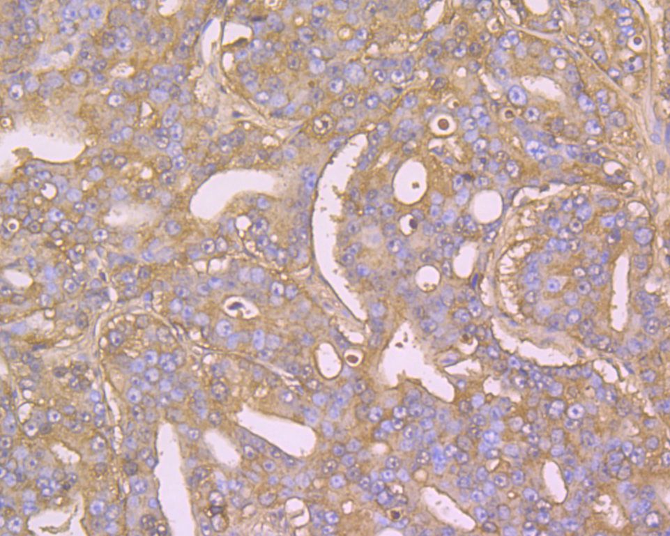 Immunohistochemical analysis of paraffin-embedded human prostate cancer tissue using anti-Albumin antibody. The section was pre-treated using heat mediated antigen retrieval with Tris-EDTA buffer (pH 8.0-8.4) for 20 minutes.The tissues were blocked in 5% BSA for 30 minutes at room temperature, washed with ddH2O and PBS, and then probed with the primary antibody (EM1901-80, 1/100) for 30 minutes at room temperature. The detection was performed using an HRP conjugated compact polymer system. DAB was used as the chromogen. Tissues were counterstained with hematoxylin and mounted with DPX.