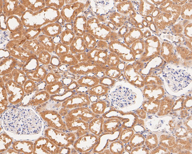 Immunohistochemical analysis of paraffin-embedded human prostate carcinoma tissue using anti-CAPZA1 antibody. The section was pre-treated using heat mediated antigen retrieval with Tris-EDTA buffer (pH 8.0-8.4) for 20 minutes.The tissues were blocked in 5% BSA for 30 minutes at room temperature, washed with ddH2O and PBS, and then probed with the primary antibody (EM1901-82, 1/50) for 30 minutes at room temperature. The detection was performed using an HRP conjugated compact polymer system. DAB was used as the chromogen. Tissues were counterstained with hematoxylin and mounted with DPX.