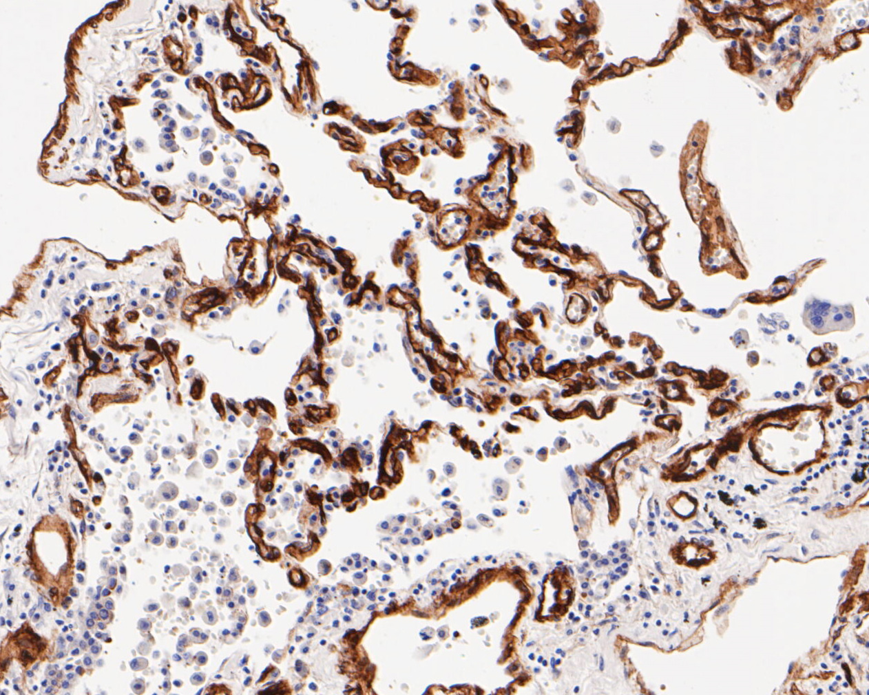Immunohistochemical analysis of paraffin-embedded human lung tissue using anti-Caveolin-1 antibody. The section was pre-treated using heat mediated antigen retrieval with Tris-EDTA buffer (pH 8.0-8.4) for 20 minutes.The tissues were blocked in 5% BSA for 30 minutes at room temperature, washed with ddH2O and PBS, and then probed with the primary antibody (EM1901-87, 1/1000) for 30 minutes at room temperature. The detection was performed using an HRP conjugated compact polymer system. DAB was used as the chromogen. Tissues were counterstained with hematoxylin and mounted with DPX.