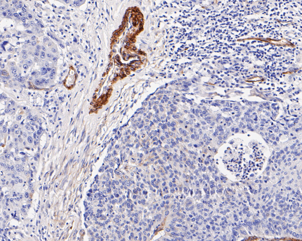 Immunohistochemical analysis of paraffin-embedded human lung carcinoma tissue using anti-Caveolin-1 antibody. The section was pre-treated using heat mediated antigen retrieval with Tris-EDTA buffer (pH 8.0-8.4) for 20 minutes.The tissues were blocked in 5% BSA for 30 minutes at room temperature, washed with ddH2O and PBS, and then probed with the primary antibody (EM1901-87, 1/1000) for 30 minutes at room temperature. The detection was performed using an HRP conjugated compact polymer system. DAB was used as the chromogen. Tissues were counterstained with hematoxylin and mounted with DPX.