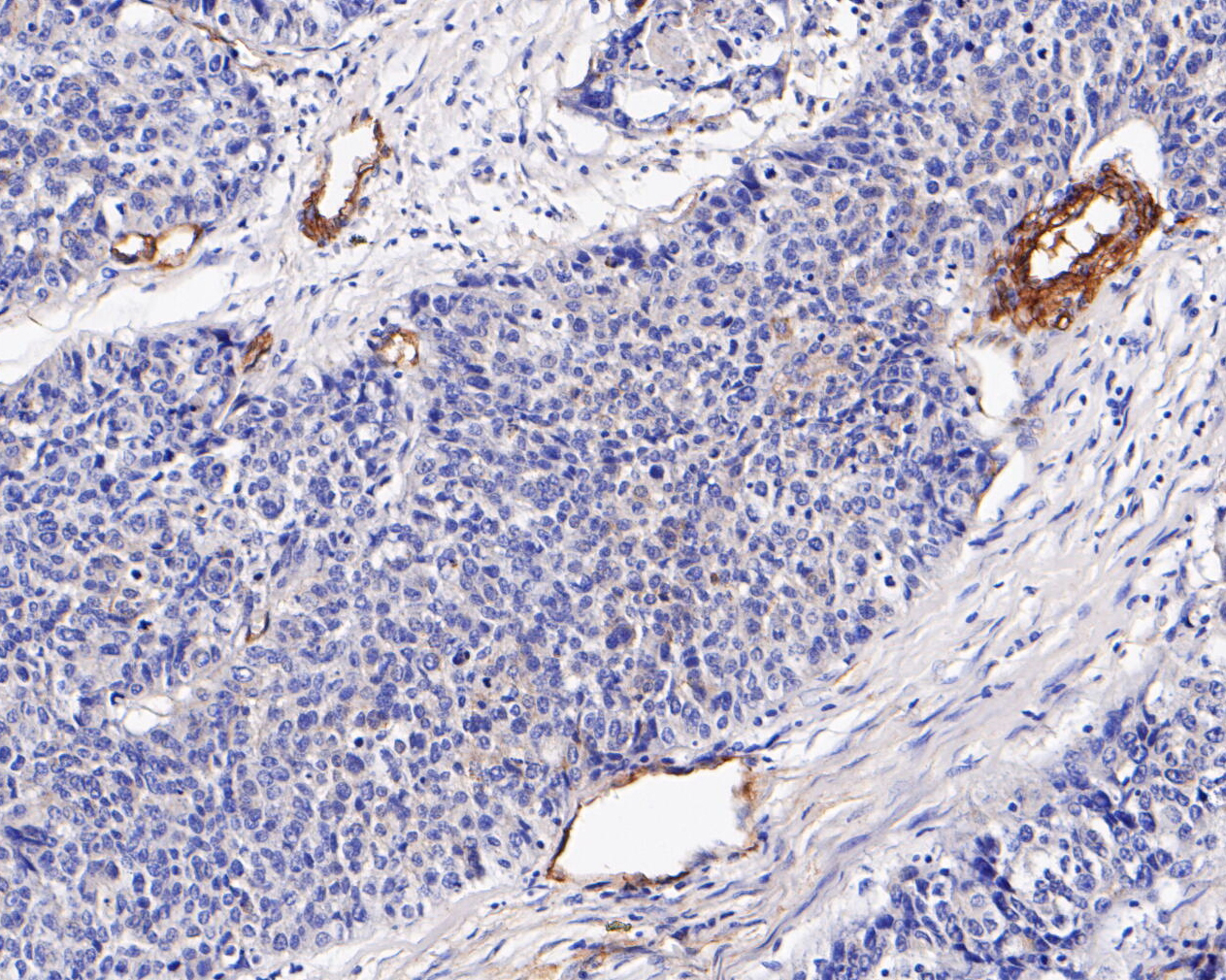 Immunohistochemical analysis of paraffin-embedded human lung carcinoma tissue using anti-Caveolin-1 antibody. The section was pre-treated using heat mediated antigen retrieval with Tris-EDTA buffer (pH 8.0-8.4) for 20 minutes.The tissues were blocked in 5% BSA for 30 minutes at room temperature, washed with ddH2O and PBS, and then probed with the primary antibody (EM1901-88, 1/2,000) for 30 minutes at room temperature. The detection was performed using an HRP conjugated compact polymer system. DAB was used as the chromogen. Tissues were counterstained with hematoxylin and mounted with DPX.