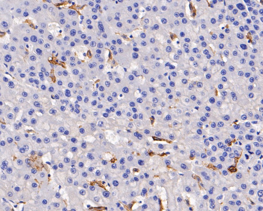 Immunohistochemical analysis of paraffin-embedded human liver carcinoma tissue using anti-CD163 antibody. The section was pre-treated using heat mediated antigen retrieval with Tris-EDTA buffer (pH 8.0-8.4) for 20 minutes.The tissues were blocked in 5% BSA for 30 minutes at room temperature, washed with ddH2O and PBS, and then probed with the primary antibody (EM1901-90, 1/200) for 30 minutes at room temperature. The detection was performed using an HRP conjugated compact polymer system. DAB was used as the chromogen. Tissues were counterstained with hematoxylin and mounted with DPX.