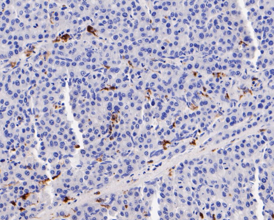Immunohistochemical analysis of paraffin-embedded human hepatic carcinoma tissue using anti-CD68 antibody. The section was pre-treated using heat mediated antigen retrieval with Tris-EDTA buffer (pH 8.0-8.4) for 20 minutes.The tissues were blocked in 5% BSA for 30 minutes at room temperature, washed with ddH2O and PBS, and then probed with the primary antibody (EM1901-93, 1/200) for 30 minutes at room temperature. The detection was performed using an HRP conjugated compact polymer system. DAB was used as the chromogen. Tissues were counterstained with hematoxylin and mounted with DPX.