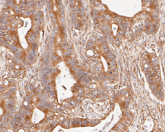 Immunohistochemical analysis of paraffin-embedded human colon carcinoma tissue using anti-Cytokeratin 20 antibody. The section was pre-treated using heat mediated antigen retrieval with Tris-EDTA buffer (pH 8.0-8.4) for 20 minutes.The tissues were blocked in 5% BSA for 30 minutes at room temperature, washed with ddH2O and PBS, and then probed with the primary antibody (EM1901-96, 1/500) for 30 minutes at room temperature. The detection was performed using an HRP conjugated compact polymer system. DAB was used as the chromogen. Tissues were counterstained with hematoxylin and mounted with DPX.