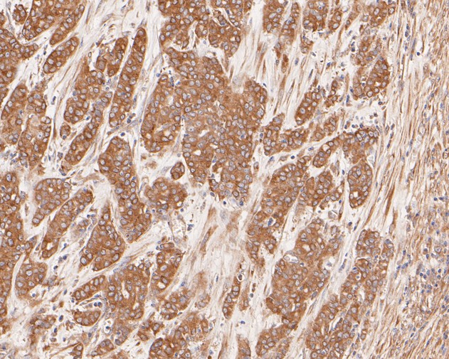 Immunohistochemical analysis of paraffin-embedded human stomach carcinoma tissue using anti-Cytokeratin 20 antibody. The section was pre-treated using heat mediated antigen retrieval with Tris-EDTA buffer (pH 8.0-8.4) for 20 minutes.The tissues were blocked in 5% BSA for 30 minutes at room temperature, washed with ddH2O and PBS, and then probed with the primary antibody (EM1901-96, 1/500) for 30 minutes at room temperature. The detection was performed using an HRP conjugated compact polymer system. DAB was used as the chromogen. Tissues were counterstained with hematoxylin and mounted with DPX.