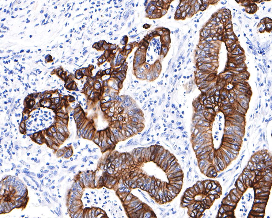 Immunohistochemical analysis of paraffin-embedded human colon carcinoma tissue with Mouse anti-Cytokeratin 20 antibody (EM1901-97) at 1/800 dilution.<br />
<br />
The section was pre-treated using heat mediated antigen retrieval with Tris-EDTA buffer (pH 9.0) for 20 minutes. The tissues were blocked in 1% BSA for 20 minutes at room temperature, washed with ddH2O and PBS, and then probed with the primary antibody (EM1901-97) at 1/800 dilution for 1 hour at room temperature. The detection was performed using an HRP conjugated compact polymer system. DAB was used as the chromogen. Tissues were counterstained with hematoxylin and mounted with DPX.