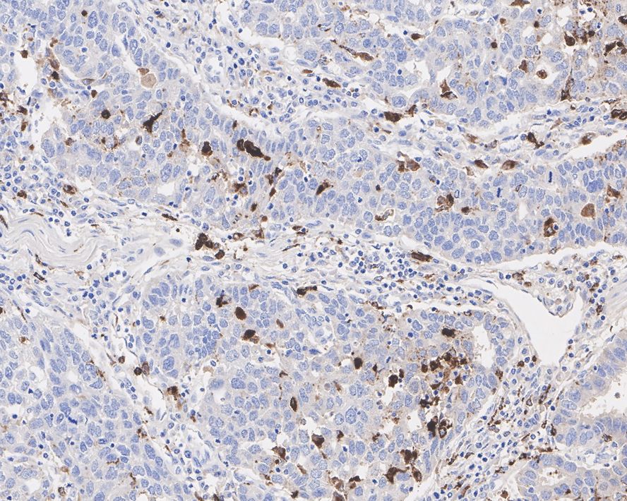 Immunohistochemical analysis of paraffin-embedded human stomach carcinoma tissue using anti-Lysozyme antibody. The section was pre-treated using heat mediated antigen retrieval with Tris-EDTA buffer (pH 8.0-8.4) for 20 minutes.The tissues were blocked in 5% BSA for 30 minutes at room temperature, washed with ddH2O and PBS, and then probed with the primary antibody (EM1901-98, 1/1,000) for 30 minutes at room temperature. The detection was performed using an HRP conjugated compact polymer system. DAB was used as the chromogen. Tissues were counterstained with hematoxylin and mounted with DPX.