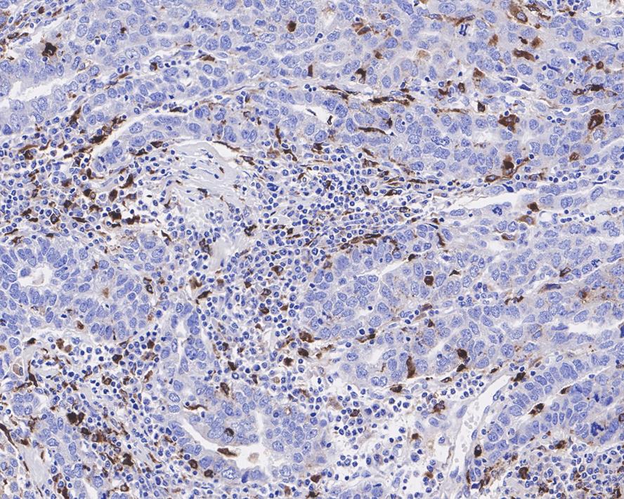 Immunohistochemical analysis of paraffin-embedded human stomach carcinoma tissue using anti-Lysozyme antibody. The section was pre-treated using heat mediated antigen retrieval with Tris-EDTA buffer (pH 8.0-8.4) for 20 minutes.The tissues were blocked in 5% BSA for 30 minutes at room temperature, washed with ddH2O and PBS, and then probed with the primary antibody (EM1901-99, 1/1,000) for 30 minutes at room temperature. The detection was performed using an HRP conjugated compact polymer system. DAB was used as the chromogen. Tissues were counterstained with hematoxylin and mounted with DPX.