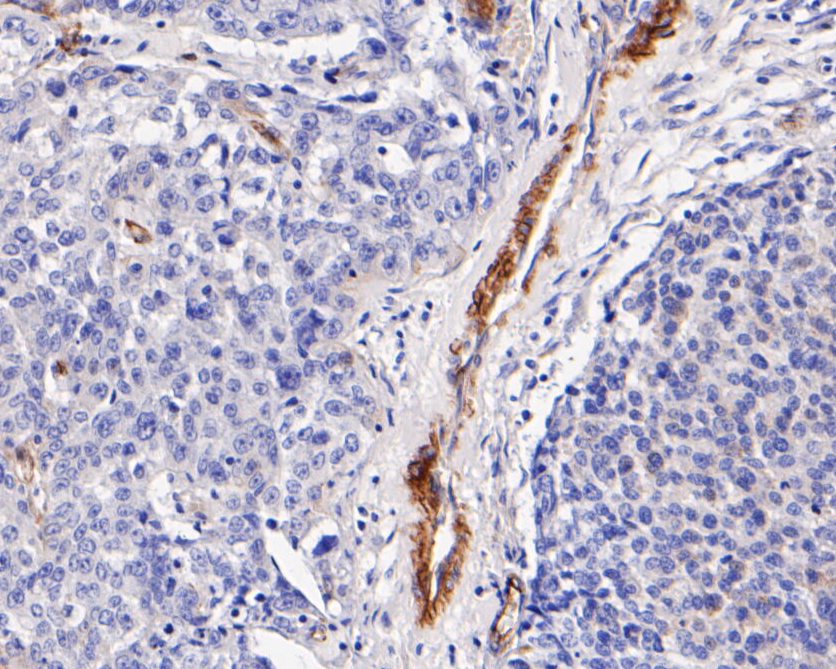 Immunohistochemical analysis of paraffin-embedded human lung carcinoma tissue using anti-Caveolin-1 antibody. The section was pre-treated using heat mediated antigen retrieval with Tris-EDTA buffer (pH 8.0-8.4) for 20 minutes.The tissues were blocked in 5% BSA for 30 minutes at room temperature, washed with ddH2O and PBS, and then probed with the primary antibody (EM1902-01, 1/1000) for 30 minutes at room temperature. The detection was performed using an HRP conjugated compact polymer system. DAB was used as the chromogen. Tissues were counterstained with hematoxylin and mounted with DPX.
