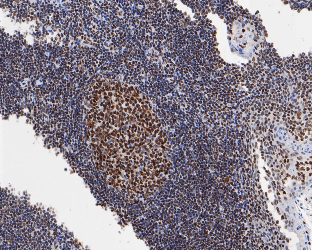 Immunohistochemical analysis of paraffin-embedded human tonsil tissue using anti-HMGB2 antibody. The section was pre-treated using heat mediated antigen retrieval with sodium citrate buffer (pH 6.0) for 20 minutes. The tissues were blocked in 5% BSA for 30 minutes at room temperature, washed with ddH2O and PBS, and then probed with the primary antibody (EM1902-06, 1/1,000)  for 30 minutes at room temperature. The detection was performed using an HRP conjugated compact polymer system. DAB was used as the chromogen. Tissues were counterstained with hematoxylin and mounted with DPX.