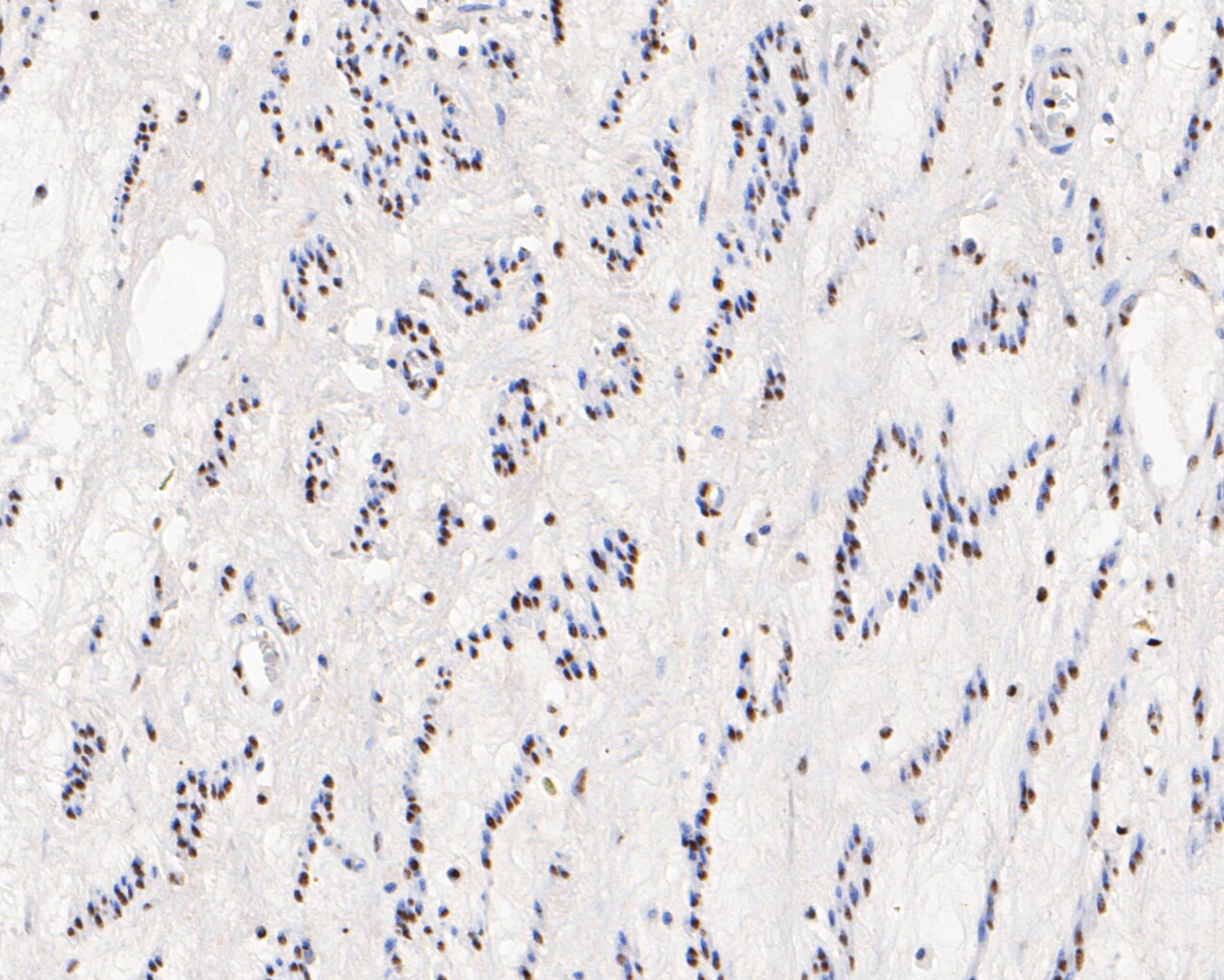 Immunohistochemical analysis of paraffin-embedded human cervical tissue using anti-HMGB2 antibody. The section was pre-treated using heat mediated antigen retrieval with sodium citrate buffer (pH 6.0) for 20 minutes. The tissues were blocked in 5% BSA for 30 minutes at room temperature, washed with ddH2O and PBS, and then probed with the primary antibody (EM1902-06, 1/1,000)  for 30 minutes at room temperature. The detection was performed using an HRP conjugated compact polymer system. DAB was used as the chromogen. Tissues were counterstained with hematoxylin and mounted with DPX.