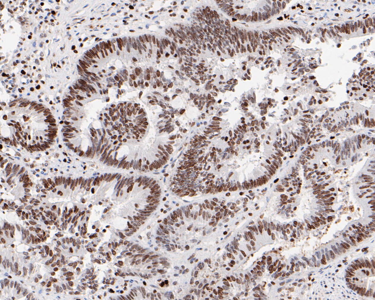 Immunohistochemical analysis of paraffin-embedded human colon carcinoma tissue using anti-HMGB2 antibody. The section was pre-treated using heat mediated antigen retrieval with sodium citrate buffer (pH 6.0) for 20 minutes. The tissues were blocked in 5% BSA for 30 minutes at room temperature, washed with ddH2O and PBS, and then probed with the primary antibody (EM1902-06, 1/1,000)  for 30 minutes at room temperature. The detection was performed using an HRP conjugated compact polymer system. DAB was used as the chromogen. Tissues were counterstained with hematoxylin and mounted with DPX.
