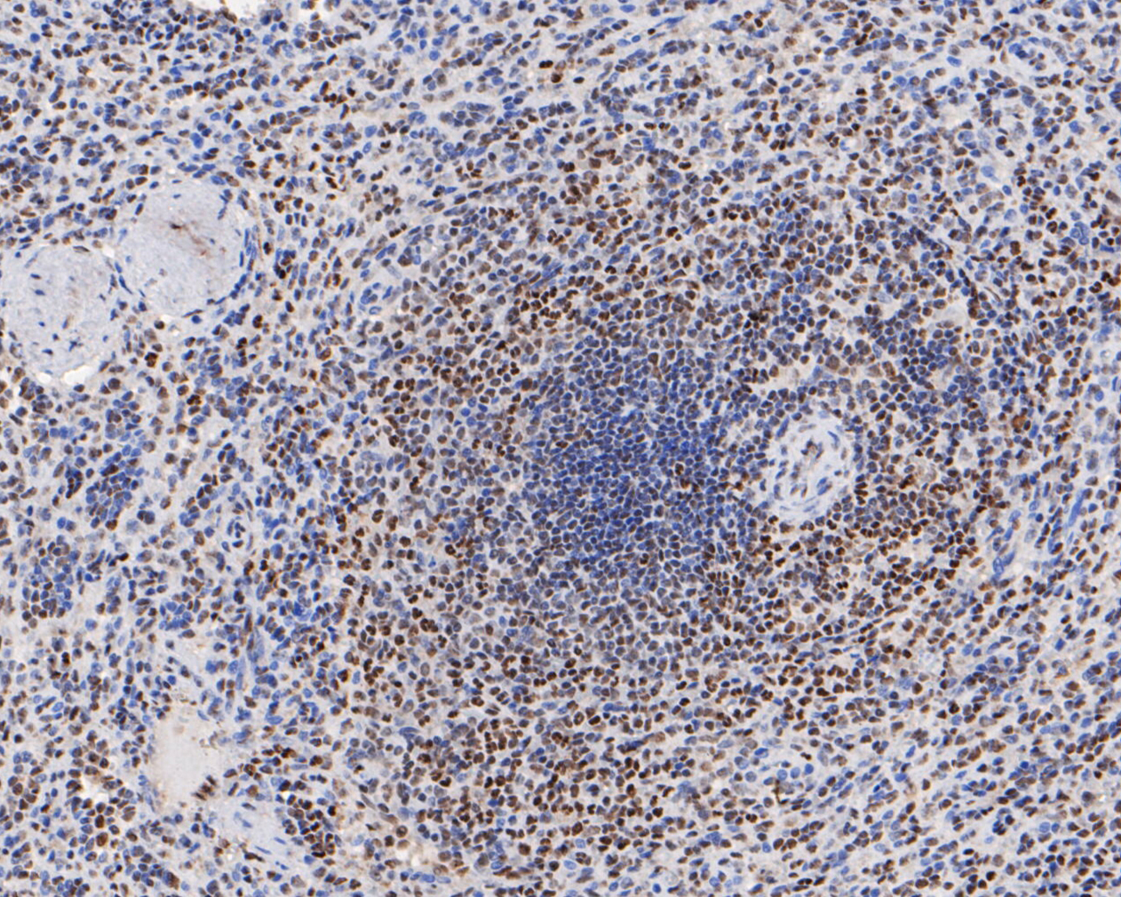 Immunohistochemical analysis of paraffin-embedded human spleen tissue using anti-HMGB2 antibody. The section was pre-treated using heat mediated antigen retrieval with sodium citrate buffer (pH 6.0) for 20 minutes. The tissues were blocked in 5% BSA for 30 minutes at room temperature, washed with ddH2O and PBS, and then probed with the primary antibody (EM1902-06, 1/1,000)  for 30 minutes at room temperature. The detection was performed using an HRP conjugated compact polymer system. DAB was used as the chromogen. Tissues were counterstained with hematoxylin and mounted with DPX.