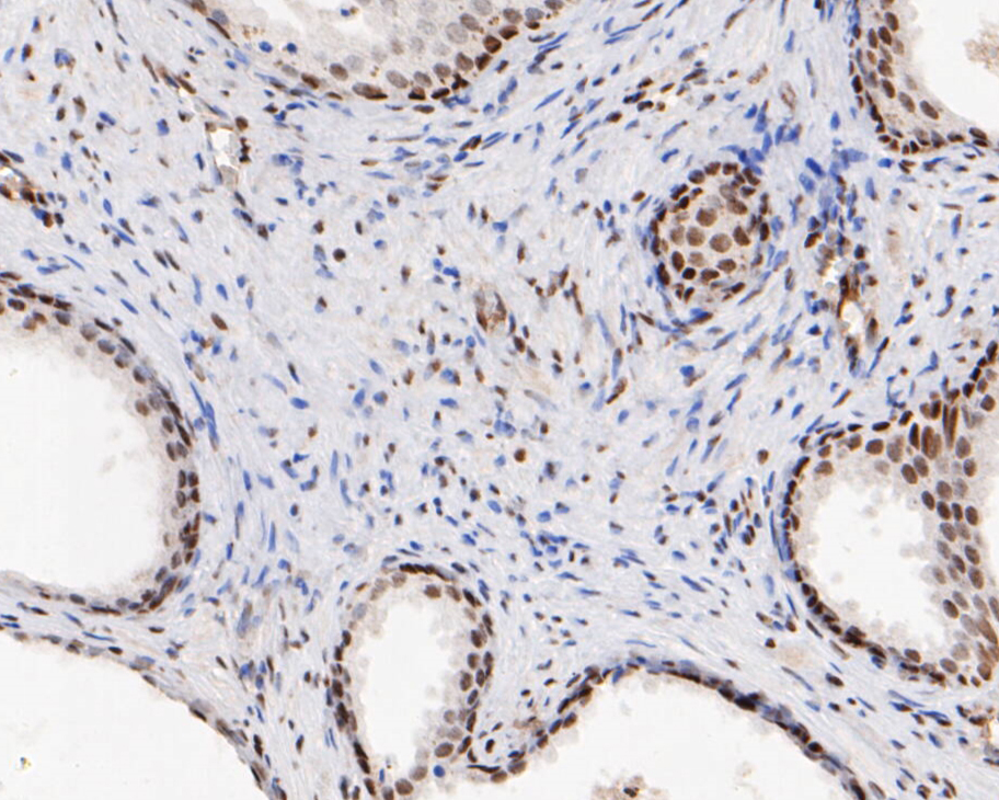 Immunohistochemical analysis of paraffin-embedded human prostate carcinoma tissue using anti-HMGB2 antibody. The section was pre-treated using heat mediated antigen retrieval with sodium citrate buffer (pH 6.0) for 20 minutes. The tissues were blocked in 5% BSA for 30 minutes at room temperature, washed with ddH2O and PBS, and then probed with the primary antibody (EM1902-06, 1/1,000)  for 30 minutes at room temperature. The detection was performed using an HRP conjugated compact polymer system. DAB was used as the chromogen. Tissues were counterstained with hematoxylin and mounted with DPX.