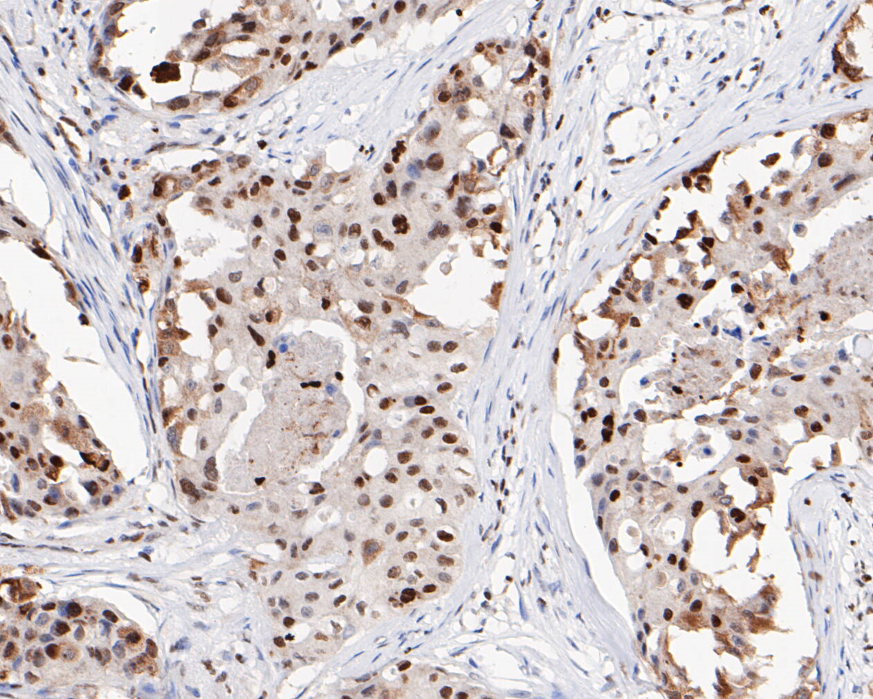 Immunohistochemical analysis of paraffin-embedded human breast carcinoma tissue using anti-HMGB2 antibody. The section was pre-treated using heat mediated antigen retrieval with sodium citrate buffer (pH 6.0) for 20 minutes. The tissues were blocked in 5% BSA for 30 minutes at room temperature, washed with ddH2O and PBS, and then probed with the primary antibody (EM1902-06, 1/1,000)  for 30 minutes at room temperature. The detection was performed using an HRP conjugated compact polymer system. DAB was used as the chromogen. Tissues were counterstained with hematoxylin and mounted with DPX.
