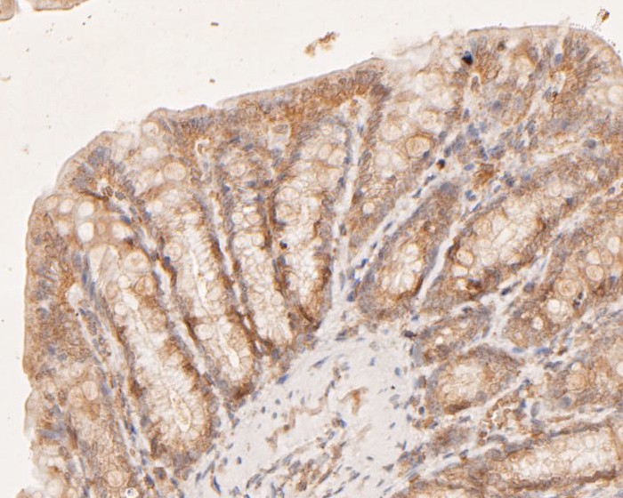 Immunohistochemical analysis of paraffin-embedded human prostate cancer tissue using anti-CASK antibody. The section was pre-treated using heat mediated antigen retrieval with Tris-EDTA buffer (pH 8.0-8.4) for 20 minutes.The tissues were blocked in 5% BSA for 30 minutes at room temperature, washed with ddH2O and PBS, and then probed with the primary antibody (EM1902-08, 1/50) for 30 minutes at room temperature. The detection was performed using an HRP conjugated compact polymer system. DAB was used as the chromogen. Tissues were counterstained with hematoxylin and mounted with DPX.