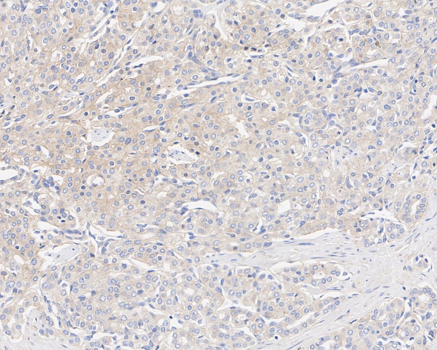 Immunohistochemical analysis of paraffin-embedded human prostate cancer tissue using anti-CASK antibody. The section was pre-treated using heat mediated antigen retrieval with Tris-EDTA buffer (pH 8.0-8.4) for 20 minutes.The tissues were blocked in 5% BSA for 30 minutes at room temperature, washed with ddH2O and PBS, and then probed with the primary antibody (EM1902-09, 1/50) for 30 minutes at room temperature. The detection was performed using an HRP conjugated compact polymer system. DAB was used as the chromogen. Tissues were counterstained with hematoxylin and mounted with DPX.