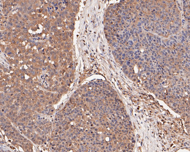Immunohistochemical analysis of paraffin-embedded human lung carcinoma tissue using anti-COX2 antibody. The section was pre-treated using heat mediated antigen retrieval with sodium citrate buffer (pH 6.0) for 20 minutes. The tissues were blocked in 5% BSA for 30 minutes at room temperature, washed with ddH2O and PBS, and then probed with the primary antibody (EM1902-11, 1/100)  for 30 minutes at room temperature. The detection was performed using an HRP conjugated compact polymer system. DAB was used as the chromogen. Tissues were counterstained with hematoxylin and mounted with DPX.