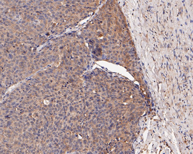 Immunohistochemical analysis of paraffin-embedded human lung carcinoma tissue using anti-COX2 antibody. The section was pre-treated using heat mediated antigen retrieval with sodium citrate buffer (pH 6.0) for 20 minutes. The tissues were blocked in 5% BSA for 30 minutes at room temperature, washed with ddH2O and PBS, and then probed with the primary antibody (EM1902-12, 1/100)  for 30 minutes at room temperature. The detection was performed using an HRP conjugated compact polymer system. DAB was used as the chromogen. Tissues were counterstained with hematoxylin and mounted with DPX.