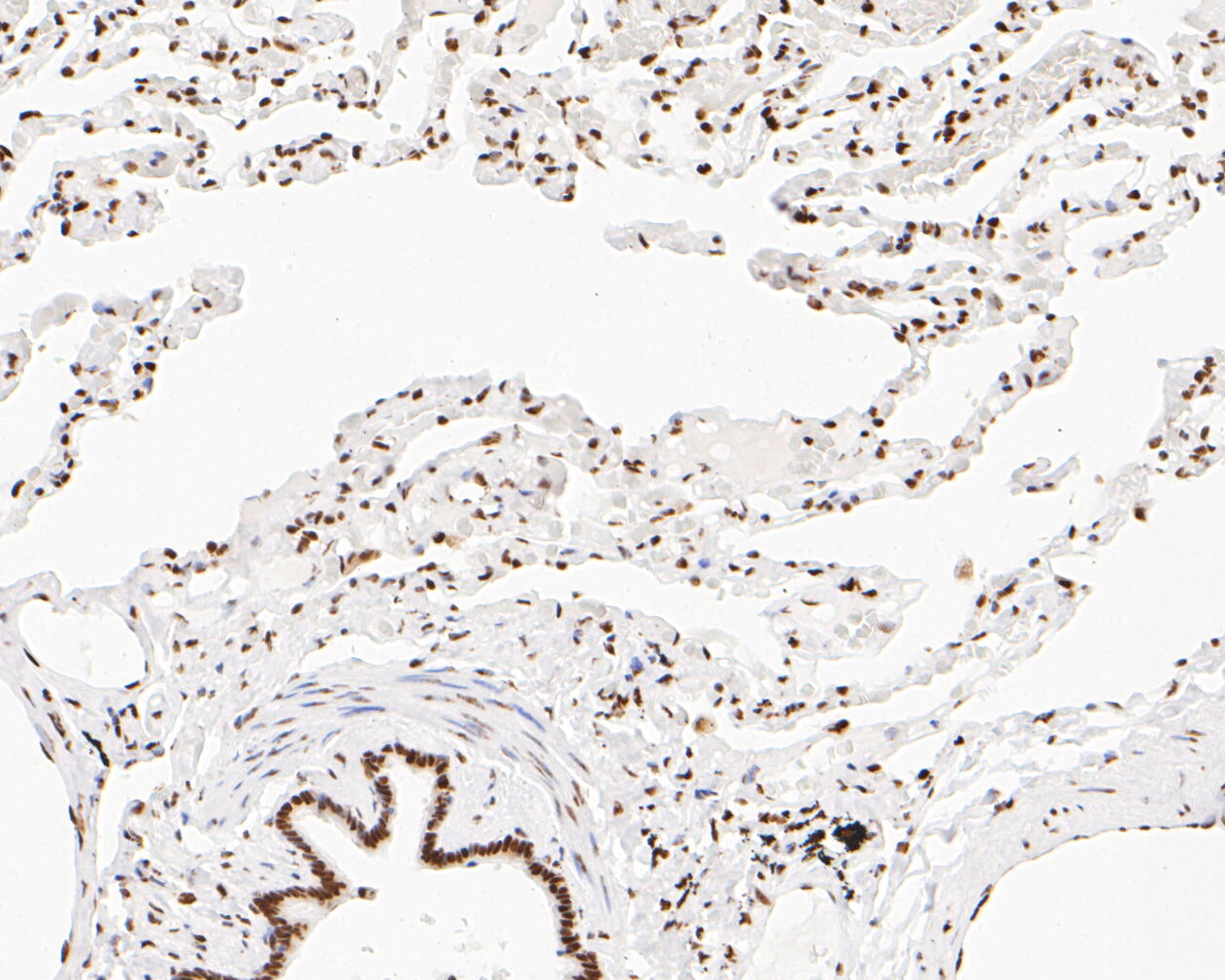 Immunohistochemical analysis of paraffin-embedded human lung tissue using anti-NuMA antibody. The section was pre-treated using heat mediated antigen retrieval with sodium citrate buffer (pH 6.0) for 20 minutes. The tissues were blocked in 5% BSA for 30 minutes at room temperature, washed with ddH2O and PBS, and then probed with the primary antibody (EM1902-16, 1/500)  for 30 minutes at room temperature. The detection was performed using an HRP conjugated compact polymer system. DAB was used as the chromogen. Tissues were counterstained with hematoxylin and mounted with DPX.