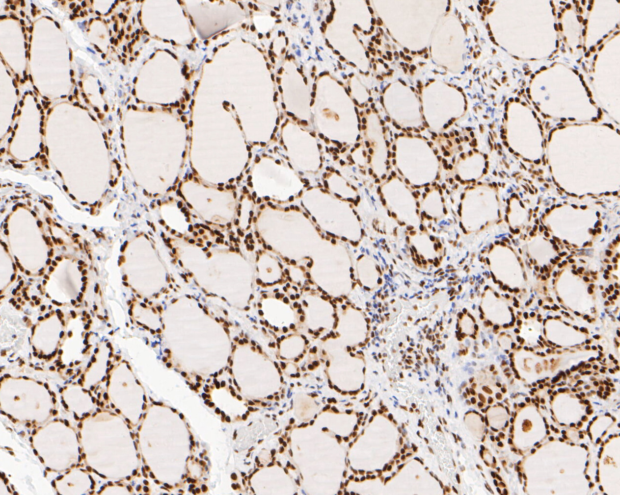 Immunohistochemical analysis of paraffin-embedded human thyroid tissue using anti-NuMA antibody. The section was pre-treated using heat mediated antigen retrieval with sodium citrate buffer (pH 6.0) for 20 minutes. The tissues were blocked in 5% BSA for 30 minutes at room temperature, washed with ddH2O and PBS, and then probed with the primary antibody (EM1902-16, 1/500)  for 30 minutes at room temperature. The detection was performed using an HRP conjugated compact polymer system. DAB was used as the chromogen. Tissues were counterstained with hematoxylin and mounted with DPX.