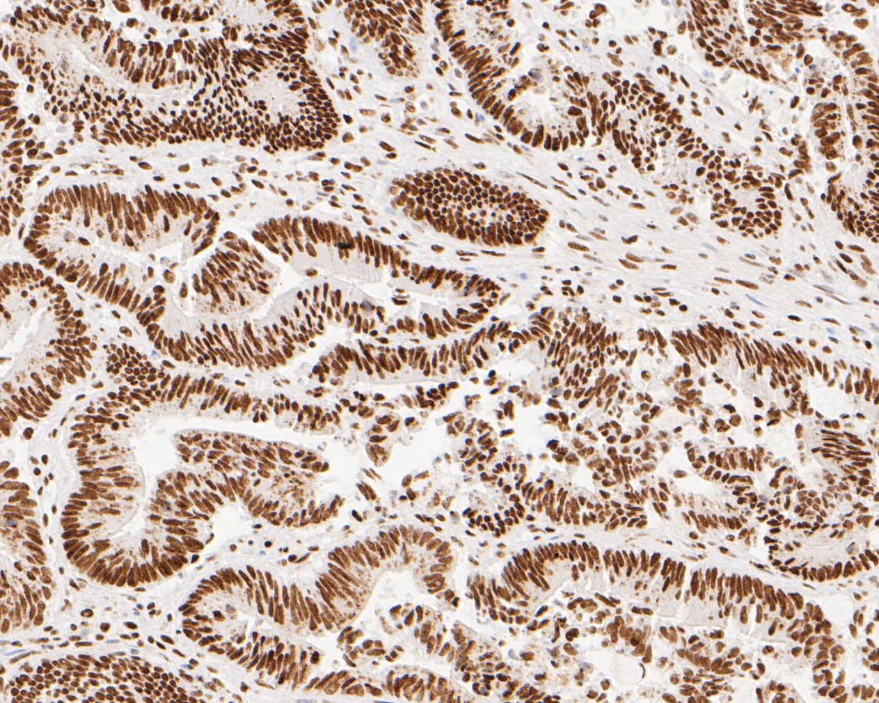 Immunohistochemical analysis of paraffin-embedded human colon carcinoma tissue using anti-NuMA antibody. The section was pre-treated using heat mediated antigen retrieval with sodium citrate buffer (pH 6.0) for 20 minutes. The tissues were blocked in 5% BSA for 30 minutes at room temperature, washed with ddH2O and PBS, and then probed with the primary antibody (EM1902-16, 1/500)  for 30 minutes at room temperature. The detection was performed using an HRP conjugated compact polymer system. DAB was used as the chromogen. Tissues were counterstained with hematoxylin and mounted with DPX.