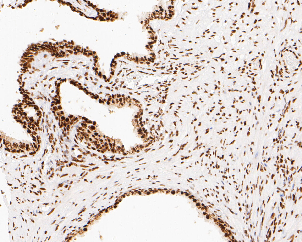 Immunohistochemical analysis of paraffin-embedded human prostate carcinoma tissue using anti-NuMA antibody. The section was pre-treated using heat mediated antigen retrieval with sodium citrate buffer (pH 6.0) for 20 minutes. The tissues were blocked in 5% BSA for 30 minutes at room temperature, washed with ddH2O and PBS, and then probed with the primary antibody (EM1902-16, 1/500)  for 30 minutes at room temperature. The detection was performed using an HRP conjugated compact polymer system. DAB was used as the chromogen. Tissues were counterstained with hematoxylin and mounted with DPX.