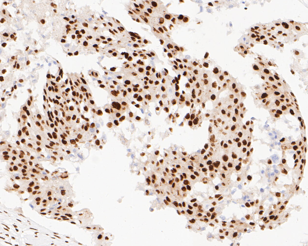Immunohistochemical analysis of paraffin-embedded human breast carcinoma tissue using anti-NuMA antibody. The section was pre-treated using heat mediated antigen retrieval with sodium citrate buffer (pH 6.0) for 20 minutes. The tissues were blocked in 5% BSA for 30 minutes at room temperature, washed with ddH2O and PBS, and then probed with the primary antibody (EM1902-16, 1/500)  for 30 minutes at room temperature. The detection was performed using an HRP conjugated compact polymer system. DAB was used as the chromogen. Tissues were counterstained with hematoxylin and mounted with DPX.