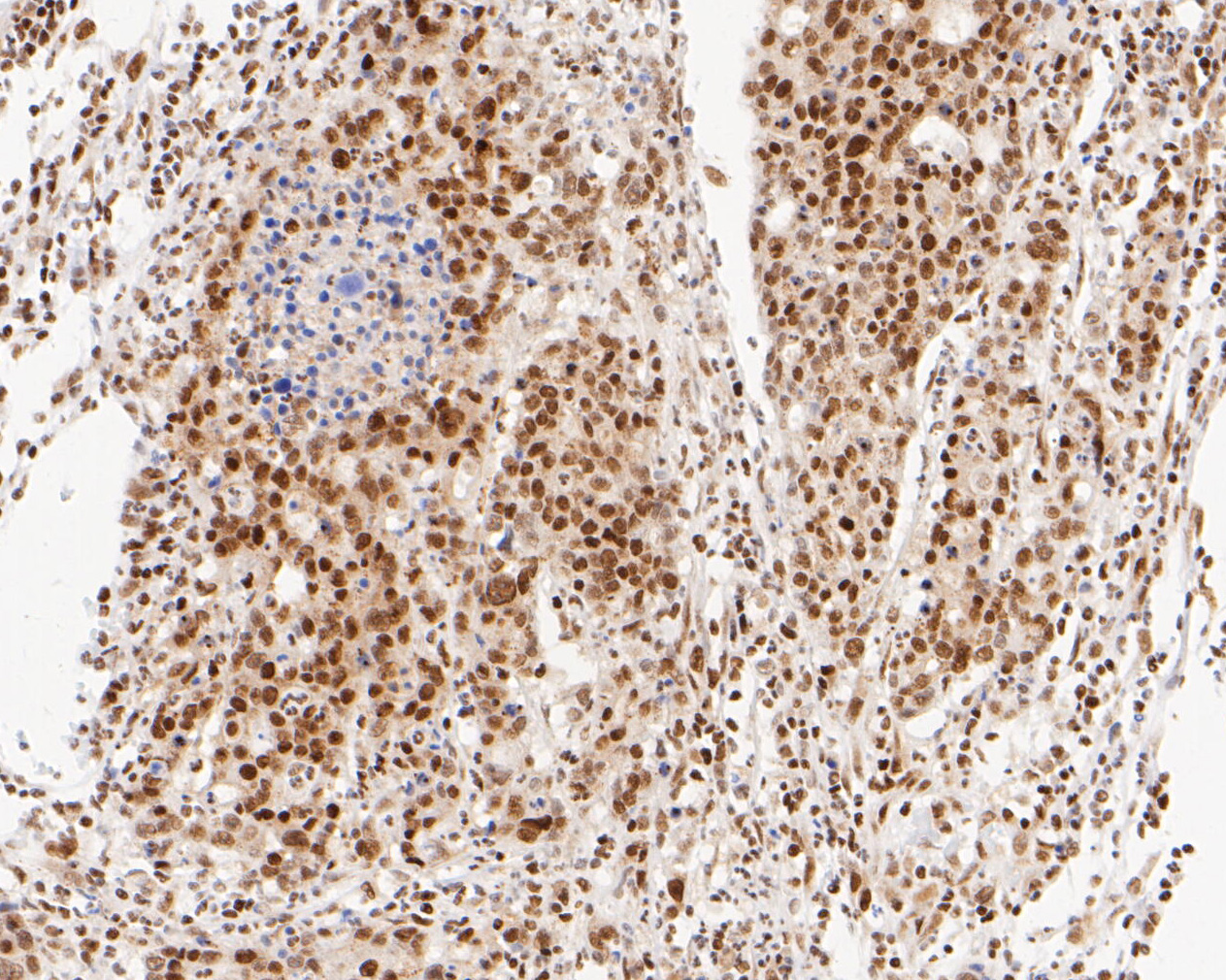 Immunohistochemical analysis of paraffin-embedded human stomach carcinoma tissue using anti-NuMA antibody. The section was pre-treated using heat mediated antigen retrieval with sodium citrate buffer (pH 6.0) for 20 minutes. The tissues were blocked in 5% BSA for 30 minutes at room temperature, washed with ddH2O and PBS, and then probed with the primary antibody (EM1902-16, 1/500)  for 30 minutes at room temperature. The detection was performed using an HRP conjugated compact polymer system. DAB was used as the chromogen. Tissues were counterstained with hematoxylin and mounted with DPX.