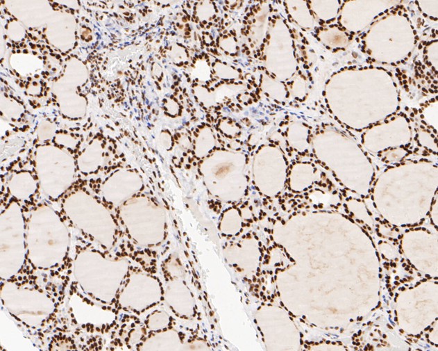 Immunohistochemical analysis of paraffin-embedded human thyroid tissue using anti-NuMA antibody. The section was pre-treated using heat mediated antigen retrieval with sodium citrate buffer (pH 6.0) for 20 minutes. The tissues were blocked in 5% BSA for 30 minutes at room temperature, washed with ddH2O and PBS, and then probed with the primary antibody (EM1902-17, 1/500)  for 30 minutes at room temperature. The detection was performed using an HRP conjugated compact polymer system. DAB was used as the chromogen. Tissues were counterstained with hematoxylin and mounted with DPX.