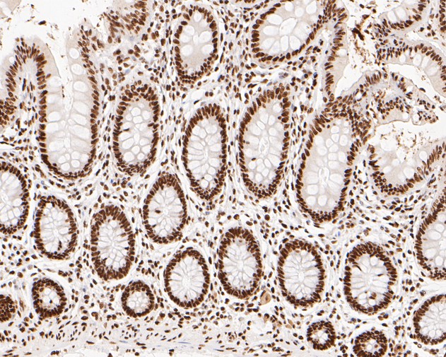 Immunohistochemical analysis of paraffin-embedded human colon tissue using anti-NuMA antibody. The section was pre-treated using heat mediated antigen retrieval with sodium citrate buffer (pH 6.0) for 20 minutes. The tissues were blocked in 5% BSA for 30 minutes at room temperature, washed with ddH2O and PBS, and then probed with the primary antibody (EM1902-17, 1/500)  for 30 minutes at room temperature. The detection was performed using an HRP conjugated compact polymer system. DAB was used as the chromogen. Tissues were counterstained with hematoxylin and mounted with DPX.