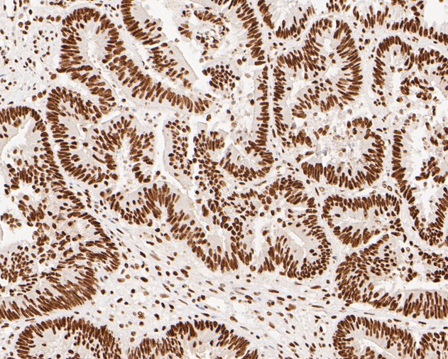 Immunohistochemical analysis of paraffin-embedded human colon carcinoma tissue using anti-NuMA antibody. The section was pre-treated using heat mediated antigen retrieval with sodium citrate buffer (pH 6.0) for 20 minutes. The tissues were blocked in 5% BSA for 30 minutes at room temperature, washed with ddH2O and PBS, and then probed with the primary antibody (EM1902-17, 1/500)  for 30 minutes at room temperature. The detection was performed using an HRP conjugated compact polymer system. DAB was used as the chromogen. Tissues were counterstained with hematoxylin and mounted with DPX.