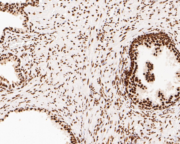 Immunohistochemical analysis of paraffin-embedded human prostate carcinoma tissue using anti-NuMA antibody. The section was pre-treated using heat mediated antigen retrieval with sodium citrate buffer (pH 6.0) for 20 minutes. The tissues were blocked in 5% BSA for 30 minutes at room temperature, washed with ddH2O and PBS, and then probed with the primary antibody (EM1902-17, 1/500)  for 30 minutes at room temperature. The detection was performed using an HRP conjugated compact polymer system. DAB was used as the chromogen. Tissues were counterstained with hematoxylin and mounted with DPX.