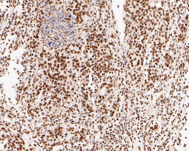 Immunohistochemical analysis of paraffin-embedded human stomach carcinoma tissue using anti-NuMA antibody. The section was pre-treated using heat mediated antigen retrieval with sodium citrate buffer (pH 6.0) for 20 minutes. The tissues were blocked in 5% BSA for 30 minutes at room temperature, washed with ddH2O and PBS, and then probed with the primary antibody (EM1902-17, 1/500)  for 30 minutes at room temperature. The detection was performed using an HRP conjugated compact polymer system. DAB was used as the chromogen. Tissues were counterstained with hematoxylin and mounted with DPX.